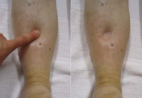 Everything You Need to Know about Edema