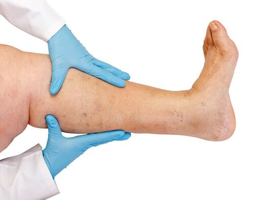 ALT TITLE Fluid retention