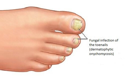 Home Remedies to Eliminate Fungal Infections