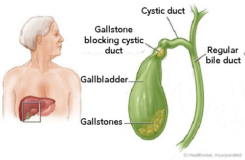 How to Know If I Have Gallstones