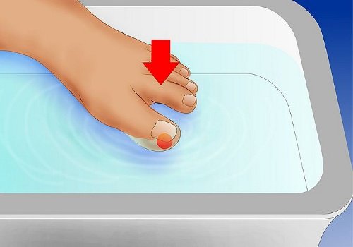 How To Treat Ingrown Toenails Correctly
