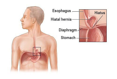Is it Possible to Treat a Hiatal Hernia?