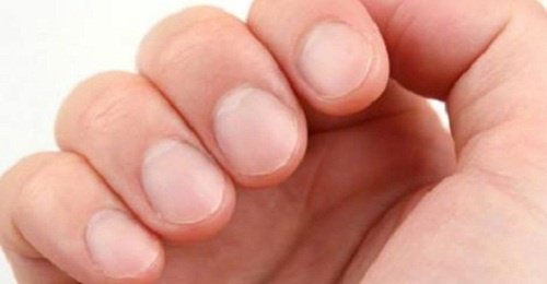8 Warning Signs Nails Give You Regarding Your Health