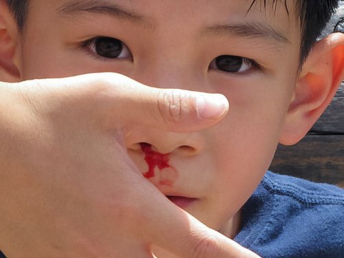 This boy gets nosebleeds often.