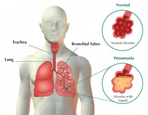Symptoms of Pneumonia and Remedies