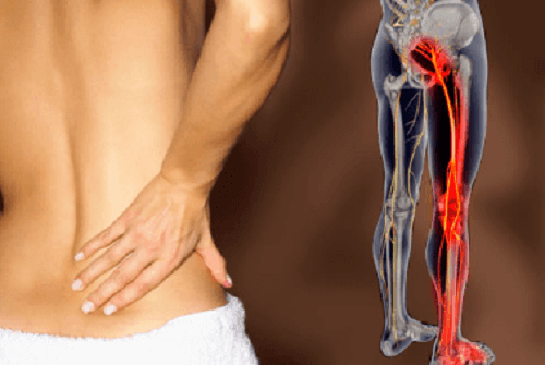 Infusions and Tips for Treating Sciatica Infusions and Tips for Treating Sciatica