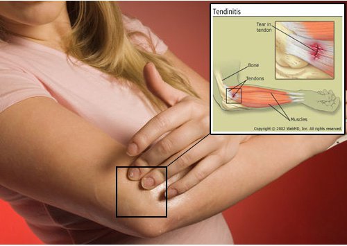 How to Improve the Symptoms of Tendonitis