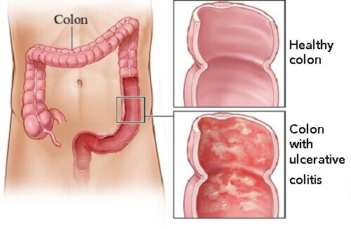 Home Treatments for Ulcerative Colitis
