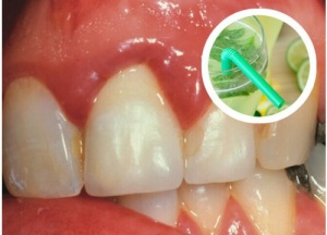 Effective Homemade Rinses for Bleeding Gums