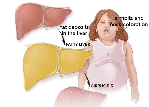 The Best Fruits to Treat Fatty Liver