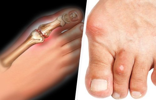 Foods that Fight Uric Acid