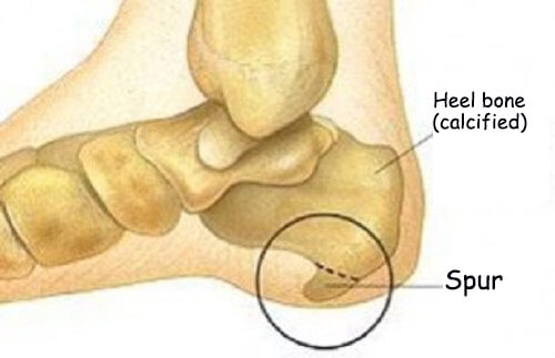 Symptoms of Heel Spurs and Treatments
