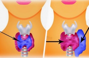 The Difference Between Hypothyroidism and Hyperthyroidism