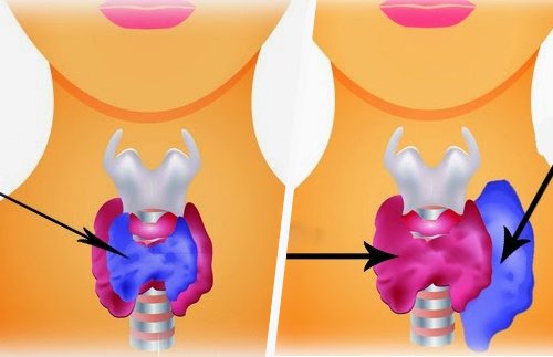 Difference Between Hypothyroidism And Hyperthyroidism