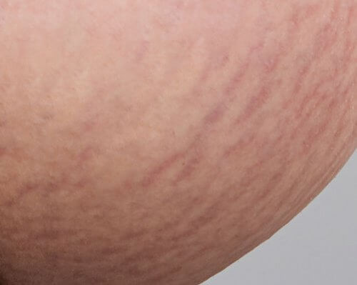 Home Remedies to Reduce Red and White Stretch Marks