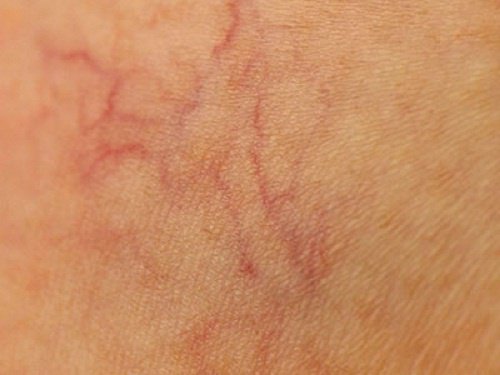 9 Ways to Naturally Prevent Spider Veins
