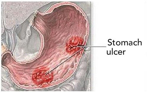 7+ Stomach Ulcer Symptoms To Be Aware Of