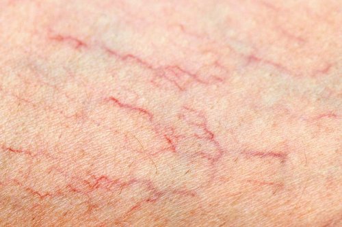 What To Do If Varicose Veins Appear