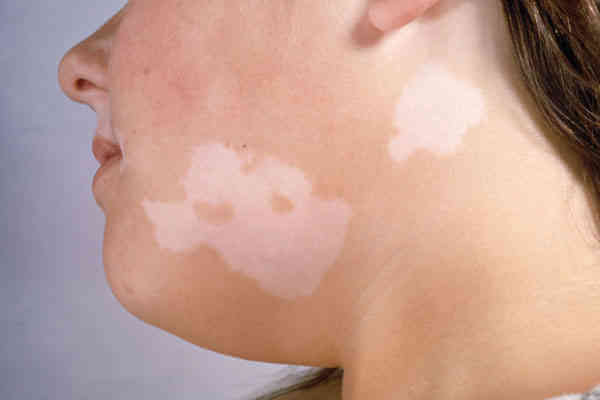 white-marks-on-the-skin-what-causes-them-step-to-health