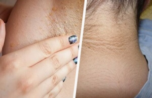 Is it Possible to Whiten Your Underarms and Neck Naturally?