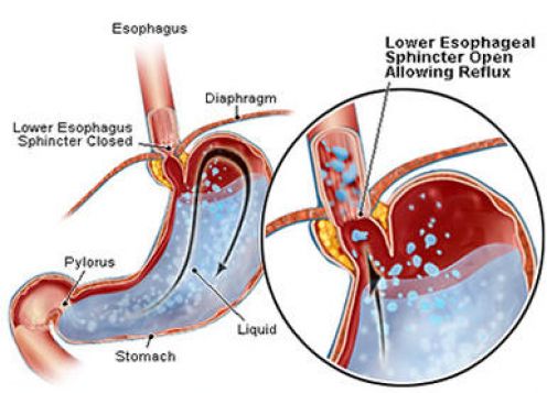 Tips to Reduce the Symptoms of Acid Reflux