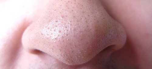 Acne and Blackheads: Green Tea Can Help