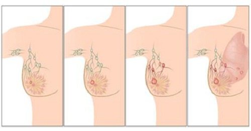 Top Causes of Breast Cancer You Should Know Top Causes of Breast Cancer You Should Know