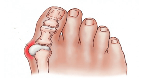 Natural Home Remedies for Bunions