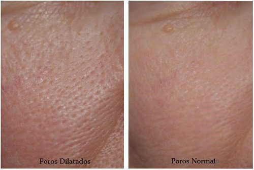 Enlarged Pores? Try These 3 Masks!