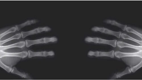 What Really Happens When You Crack Your Knuckles