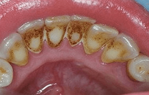 How to Remove Plaque and Improve Oral Health How to Remove Plaque and Improve Oral Health