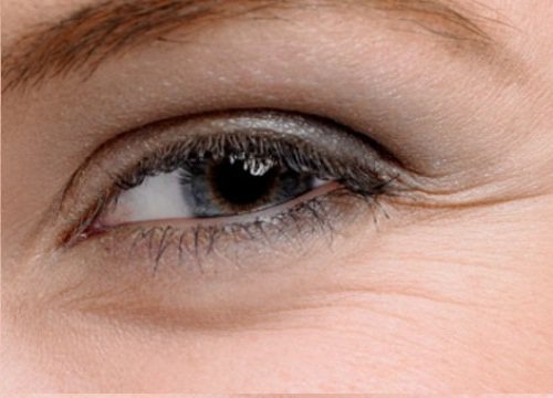 Bags Under the Eyes eye