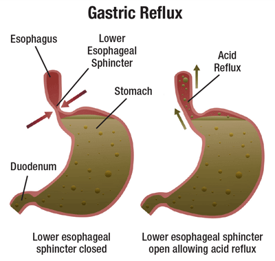 3 reflux