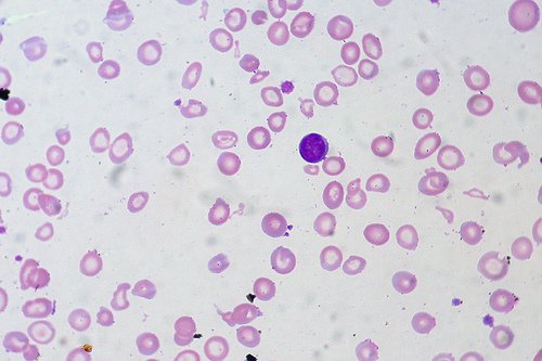 5 anemia
