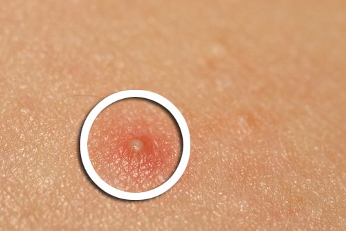 what acne can reveal about our health