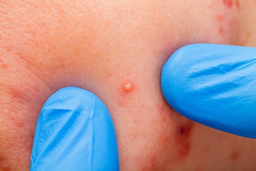 what acne and pimples can reveal about our health