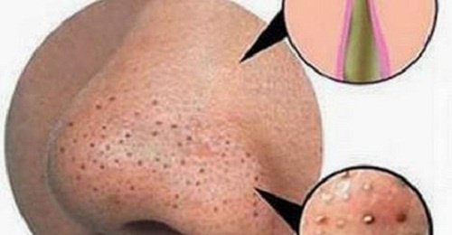 How to eliminate pimples and blackheads naturally How to eliminate pimples and blackheads naturally