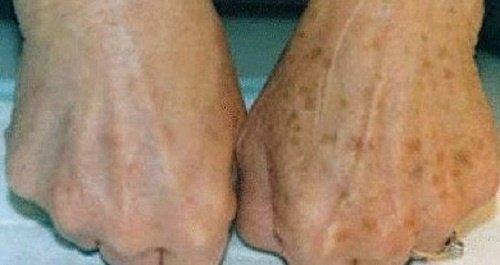 Hand Blemishes: How to Diminish Them?
