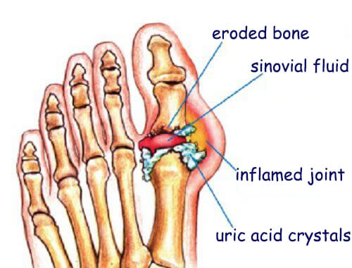 How To Naturally Get Rid Of Uric Acid Crystals In The Joints