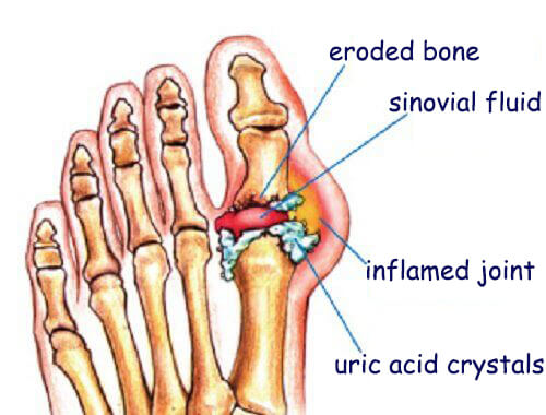 How to Naturally Get Rid of Uric Acid Crystals in the Joints