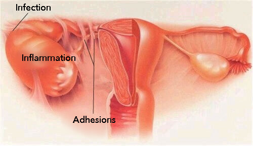 Symptoms of Pelvic Inflammatory Disease (PID)