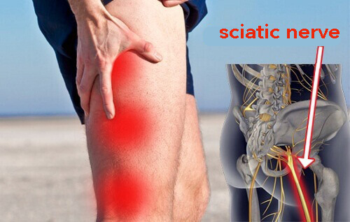 Natural Home Remedies to Treat Sciatica Natural Home Remedies to Treat Sciatica