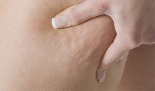 fight-cellulite fight cellulite