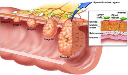 Different stages of colon polyps