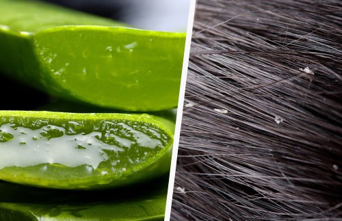 Effective Natural Dandruff Remedies
