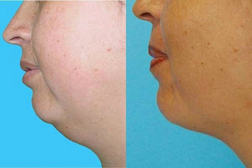 Eliminate Your Double Chin without Surgery!
