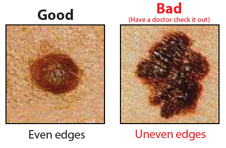 Good and bad moles.