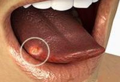 Tongue ulcer.