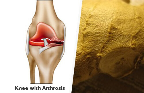 How to Relieve Symptoms of Osteoarthritis