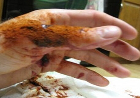 This Gel Stops Bleeding in Only 10 Seconds